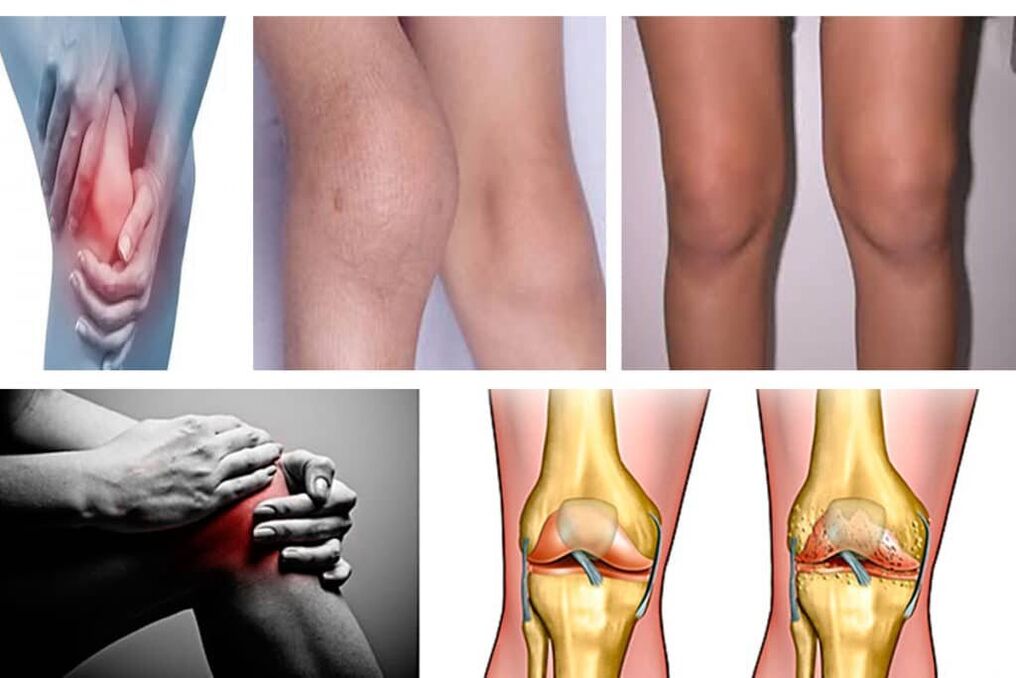Osteoarthritis, das heißt