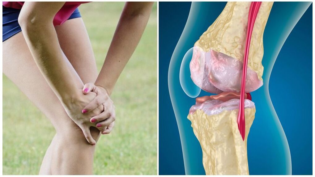 Symptome einer Arthrose