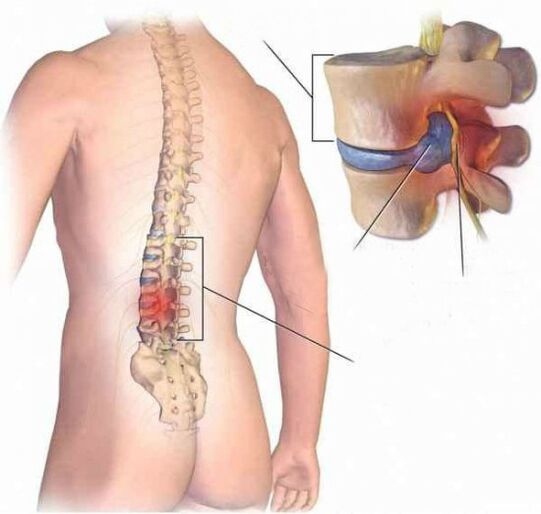 Zwischenvertebralhernie